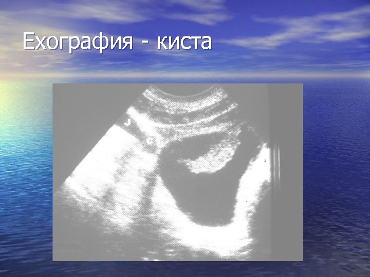 Ехография - киста 