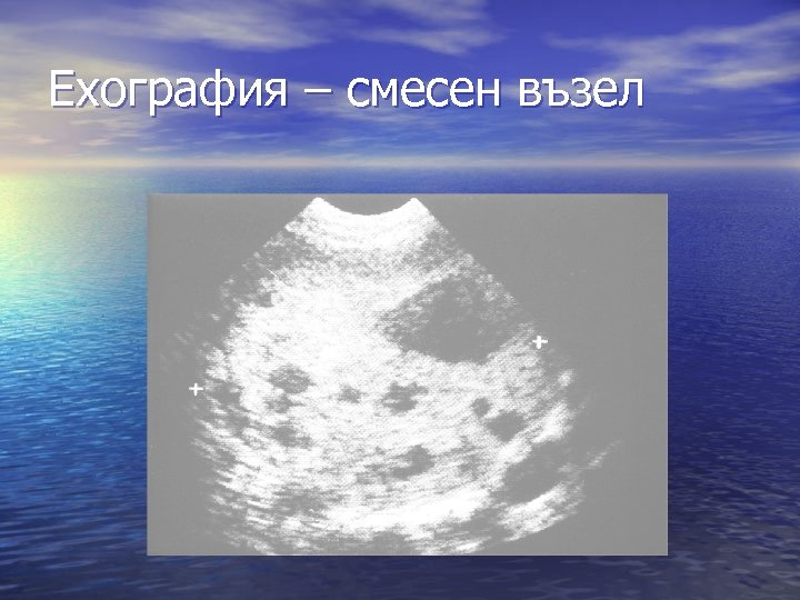 Ехография – смесен възел 