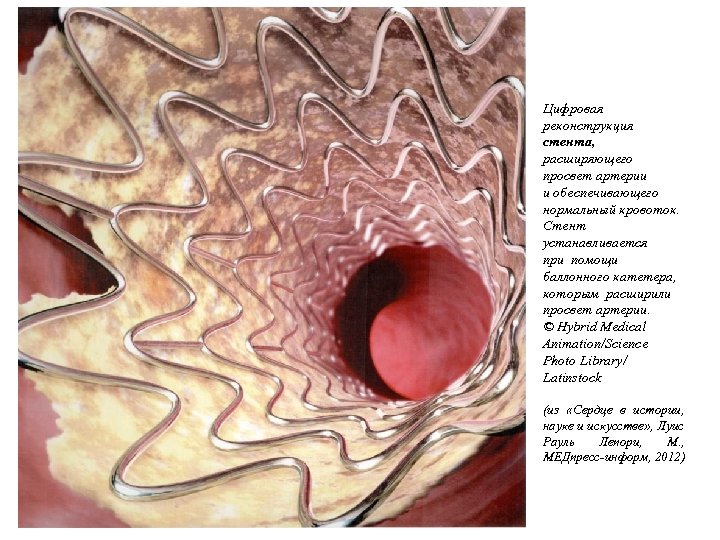 Цифровая реконструкция стента, расширяющего просвет артерии и обеспечивающего нормальный кровоток. Стент устанавливается при помощи
