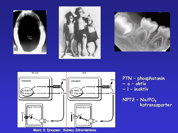 PTN – phosphatonin ~ a – aktív ~ i – inaktív NPT 2 –