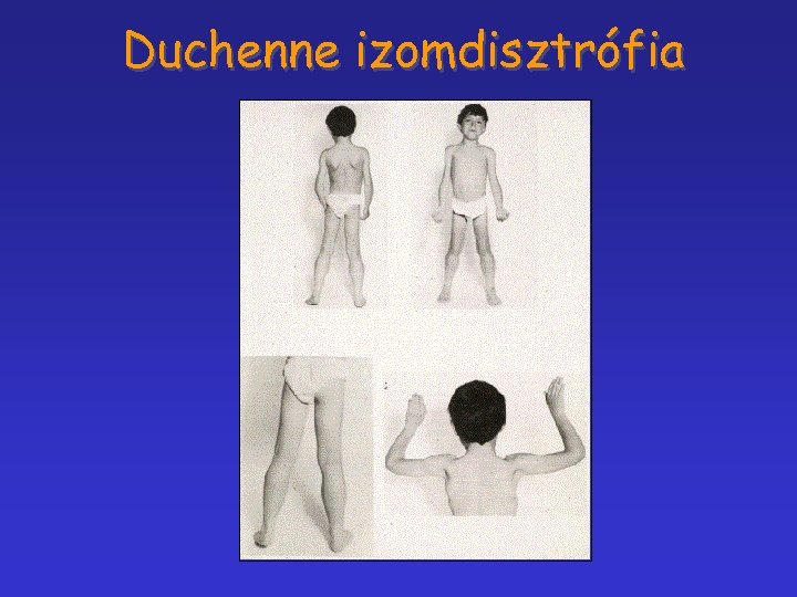 Duchenne izomdisztrófia 