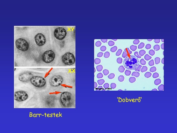 XY XX ‘Dobverő’ Barr-testek 