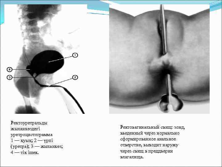 Ректоуретральды жыланкөздегі уретроцистограмма 1 — қуық; 2 — үрпі (уретра); 3 — жыланкөз; 4