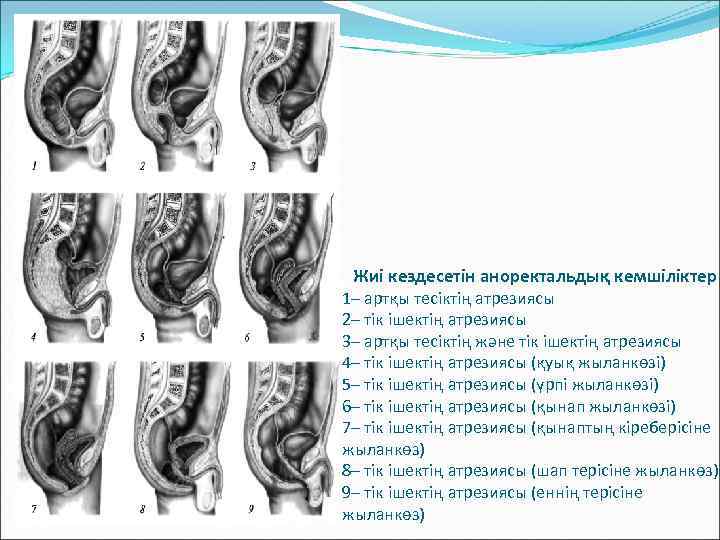Жиі кездесетін аноректальдық кемшіліктер 1– артқы тесіктің атрезиясы 2– тік ішектің атрезиясы 3– артқы