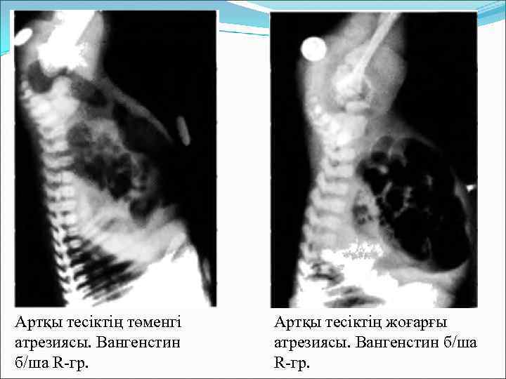 Артқы тесіктің төменгі атрезиясы. Вангенстин б/ша R-гр. Артқы тесіктің жоғарғы атрезиясы. Вангенстин б/ша R-гр.
