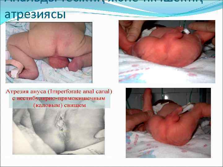 Анальды тесіктің және тік ішектің атрезиясы 