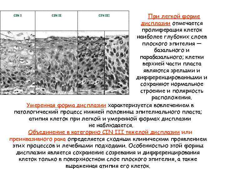 При легкой форме дисплазии отмечается пролиферация клеток наиболее глубоких слоев плоского эпителия — базального