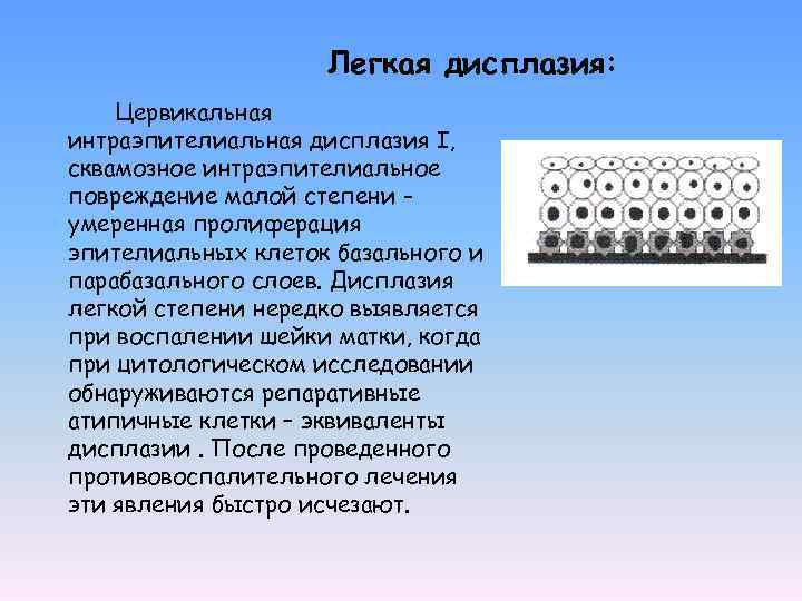 Легкая дисплазия: Цервикальная интраэпителиальная дисплазия I, сквамозное интраэпителиальное повреждение малой степени умеренная пролиферация эпителиальных