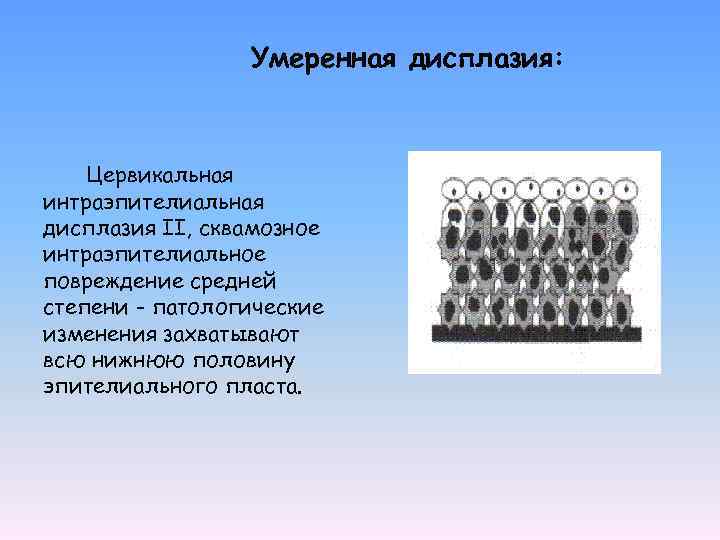 Умеренная дисплазия: Цервикальная интраэпителиальная дисплазия II, сквамозное интраэпителиальное повреждение средней степени - патологические изменения