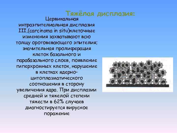 Тяжёлая дисплазия: Цервикальная интраэпителиальная дисплазия III, (carcinoma in situ)клеточные изменения захватывают всю толщу ороговевающего