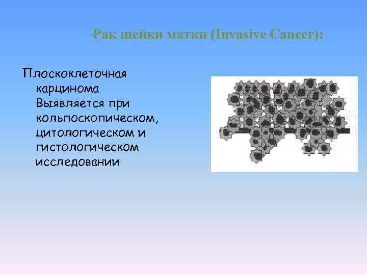 Рак шейки матки (Invasive Cancer): Плоскоклеточная карцинома Выявляется при кольпоскопическом, цитологическом и гистологическом исследовании