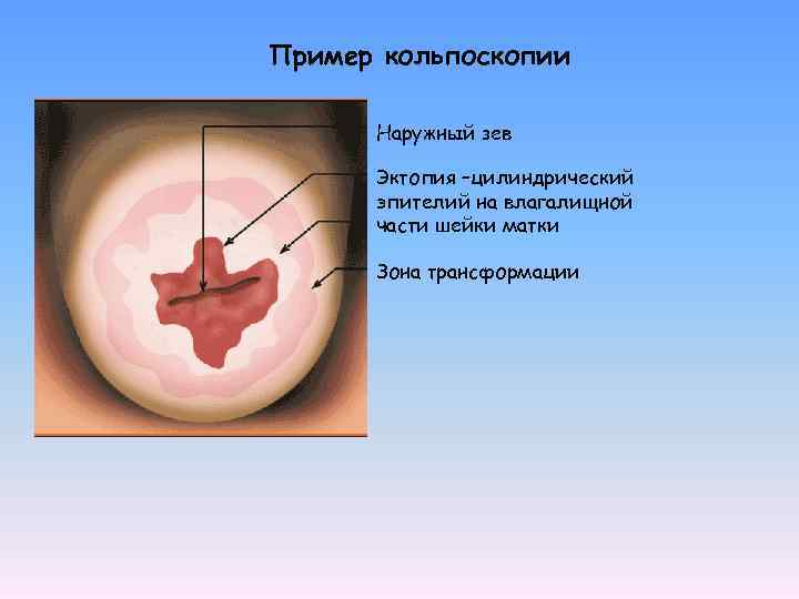 Пример кольпоскопии Наружный зев Эктопия –цилиндрический эпителий на влагалищной части шейки матки Зона трансформации