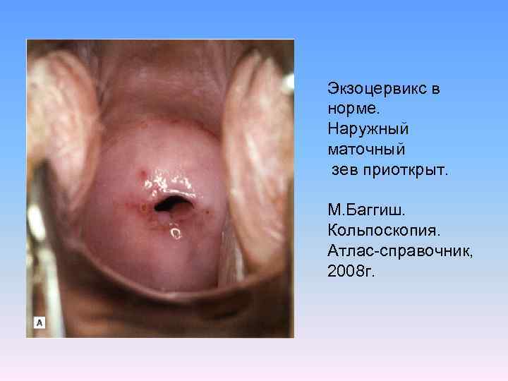 Экзоцервикс в норме. Наружный маточный зев приоткрыт. М. Баггиш. Кольпоскопия. Атлас-справочник, 2008 г. 