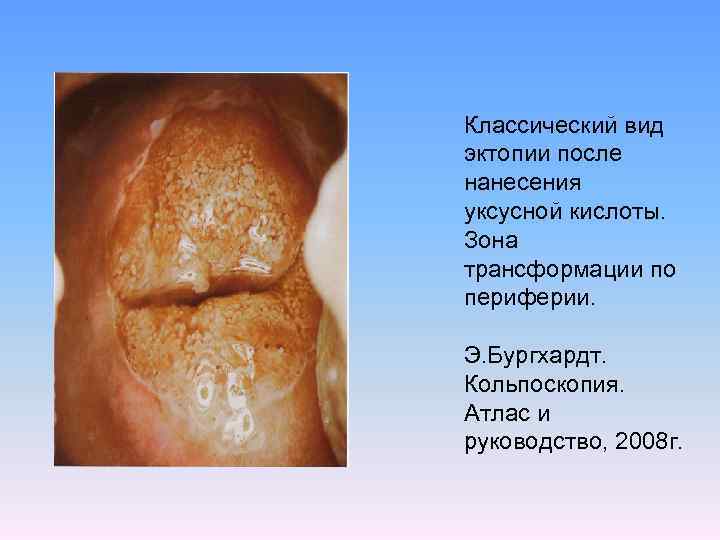 Классический вид эктопии после нанесения уксусной кислоты. Зона трансформации по периферии. Э. Бургхардт. Кольпоскопия.