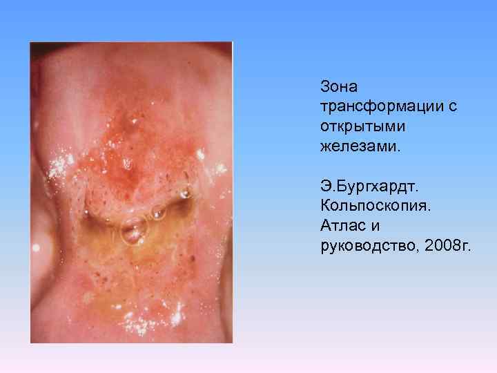 Зона трансформации с открытыми железами. Э. Бургхардт. Кольпоскопия. Атлас и руководство, 2008 г. 