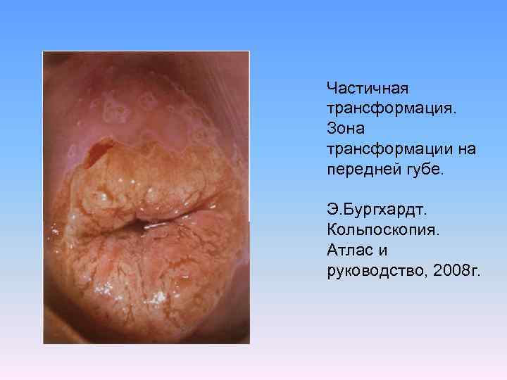 Частичная трансформация. Зона трансформации на передней губе. Э. Бургхардт. Кольпоскопия. Атлас и руководство, 2008