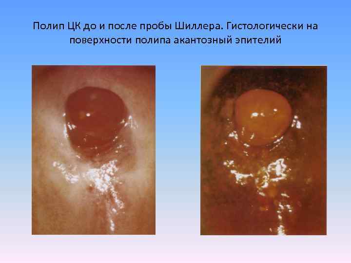 Полип ЦК до и после пробы Шиллера. Гистологически на поверхности полипа акантозный эпителий 