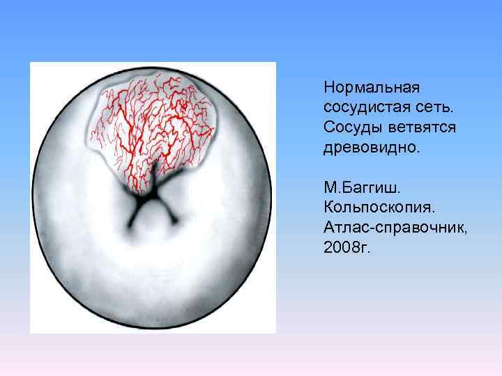 Нормальная сосудистая сеть. Сосуды ветвятся древовидно. М. Баггиш. Кольпоскопия. Атлас-справочник, 2008 г. 