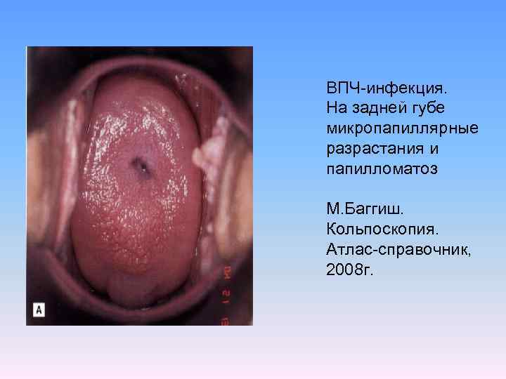 ВПЧ-инфекция. На задней губе микропапиллярные разрастания и папилломатоз М. Баггиш. Кольпоскопия. Атлас-справочник, 2008 г.