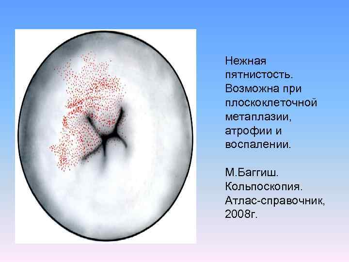 Нежная пятнистость. Возможна при плоскоклеточной метаплазии, атрофии и воспалении. М. Баггиш. Кольпоскопия. Атлас-справочник, 2008