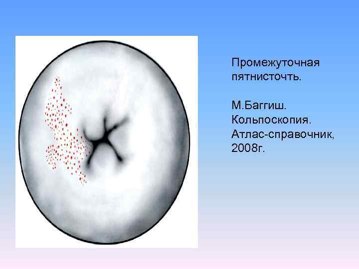 Промежуточная пятнисточть. М. Баггиш. Кольпоскопия. Атлас-справочник, 2008 г. 