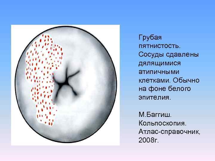 Грубая пятнистость. Сосуды сдавлены дялящимися атипичными клетками. Обычно на фоне белого эпителия. М. Баггиш.