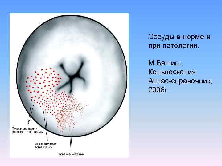 Кольпоскопия нормальная картина