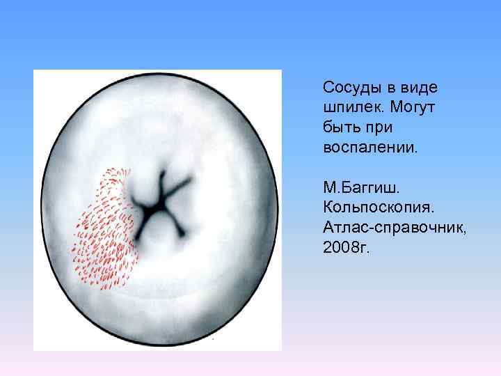 Сосуды в виде шпилек. Могут быть при воспалении. М. Баггиш. Кольпоскопия. Атлас-справочник, 2008 г.