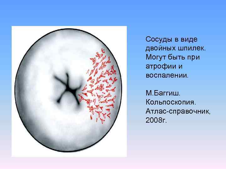 Сосуды в виде двойных шпилек. Могут быть при атрофии и воспалении. М. Баггиш. Кольпоскопия.