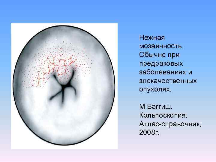 Нежная мозаичность. Обычно при предраковых заболеваниях и злокачественных опухолях. М. Баггиш. Кольпоскопия. Атлас-справочник, 2008