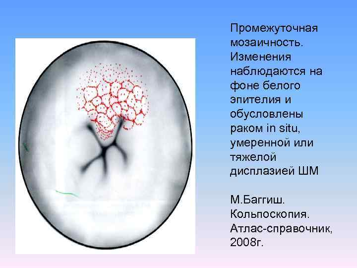 Промежуточная мозаичность. Изменения наблюдаются на фоне белого эпителия и обусловлены раком in situ, умеренной