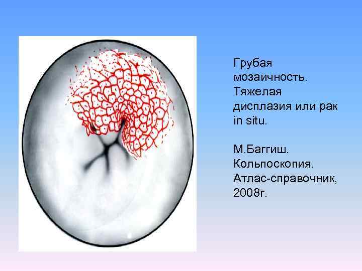 Грубая мозаичность. Тяжелая дисплазия или рак in situ. М. Баггиш. Кольпоскопия. Атлас-справочник, 2008 г.