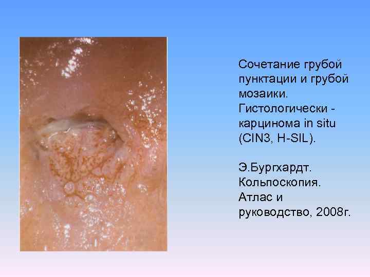 Сочетание грубой пунктации и грубой мозаики. Гистологически карцинома in situ (CIN 3, H-SIL). Э.