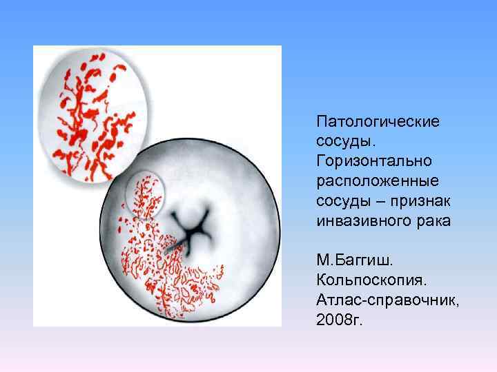 Патологические сосуды. Горизонтально расположенные сосуды – признак инвазивного рака М. Баггиш. Кольпоскопия. Атлас-справочник, 2008