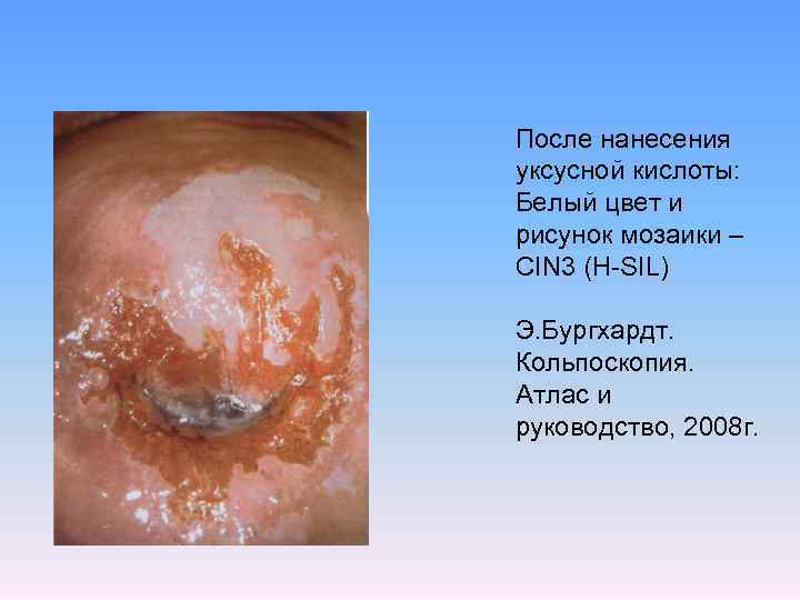 После нанесения уксусной кислоты: Белый цвет и рисунок мозаики – CIN 3 (H-SIL) Э.