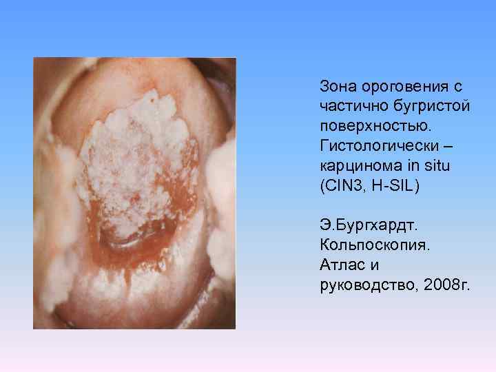 Зона ороговения с частично бугристой поверхностью. Гистологически – карцинома in situ (CIN 3, H-SIL)