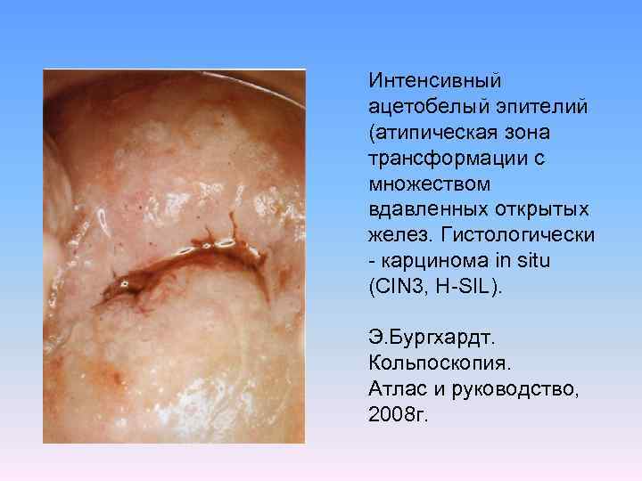 Интенсивный ацетобелый эпителий (атипическая зона трансформации с множеством вдавленных открытых желез. Гистологически - карцинома