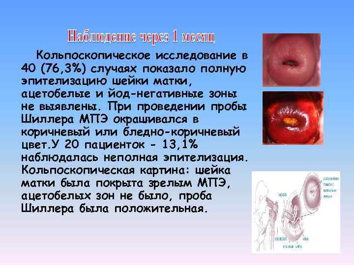  Кольпоскопическое исследование в 40 (76, 3%) случаях показало полную эпителизацию шейки матки, ацетобелые