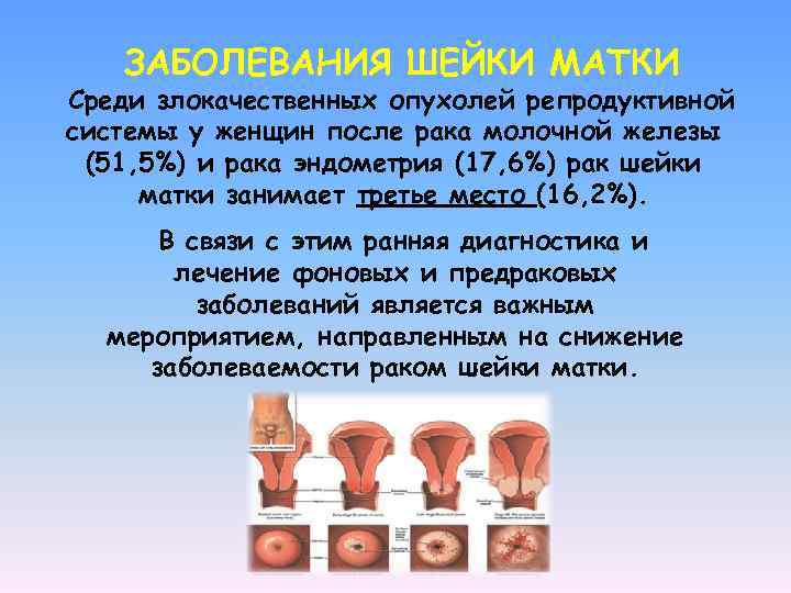 ЗАБОЛЕВАНИЯ ШЕЙКИ МАТКИ Среди злокачественных опухолей репродуктивной системы у женщин после рака молочной железы