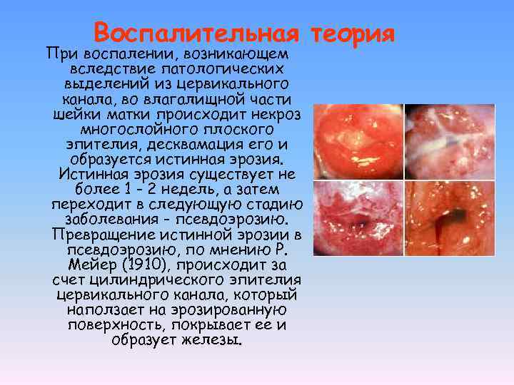 Воспалительная теория При воспалении, возникающем вследствие патологических выделений из цервикального канала, во влагалищной части