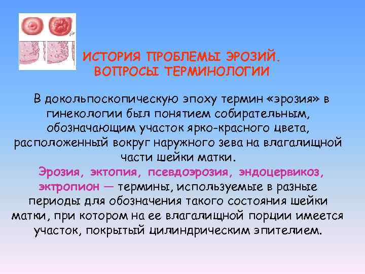 ИСТОРИЯ ПРОБЛЕМЫ ЭРОЗИЙ. ВОПРОСЫ ТЕРМИНОЛОГИИ В докольпоскопическую эпоху термин «эрозия» в гинекологии был понятием