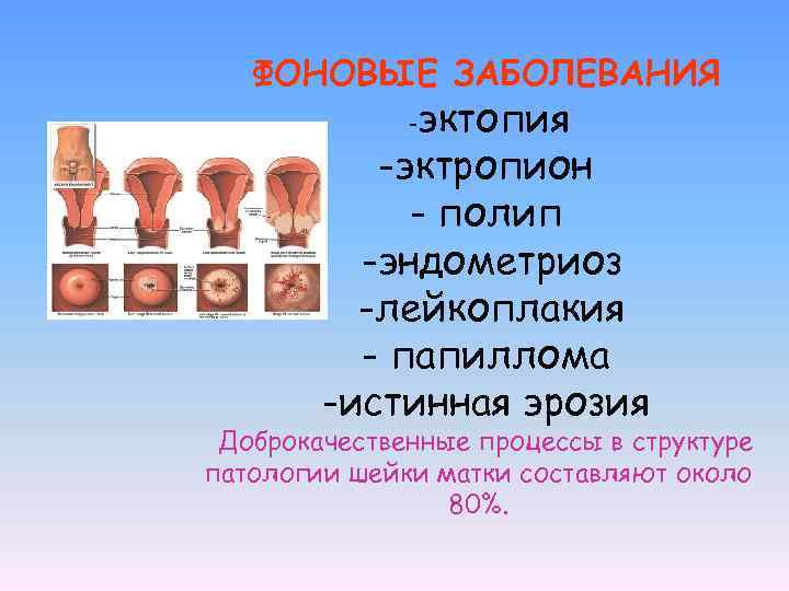 ФОНОВЫЕ ЗАБОЛЕВАНИЯ эктопия -эктропион - полип -эндометриоз -лейкоплакия - папиллома -истинная эрозия - Доброкачественные