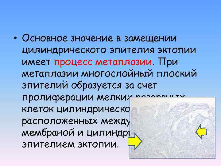  • Основное значение в замещении цилиндрического эпителия эктопии имеет процесс метаплазии. При метаплазии