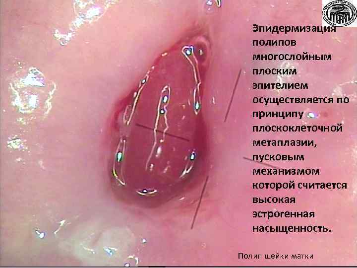 Эпидермизация полипов многослойным плоским эпителием осуществляется по принципу плоскоклеточной метаплазии, пусковым механизмом которой считается