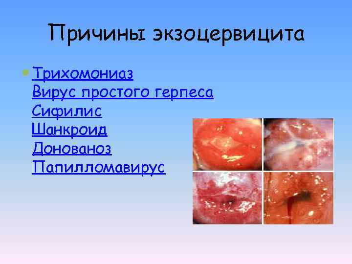 Причины экзоцервицита Трихомониаз Вирус простого герпеса Сифилис Шанкроид Донованоз Папилломавирус 