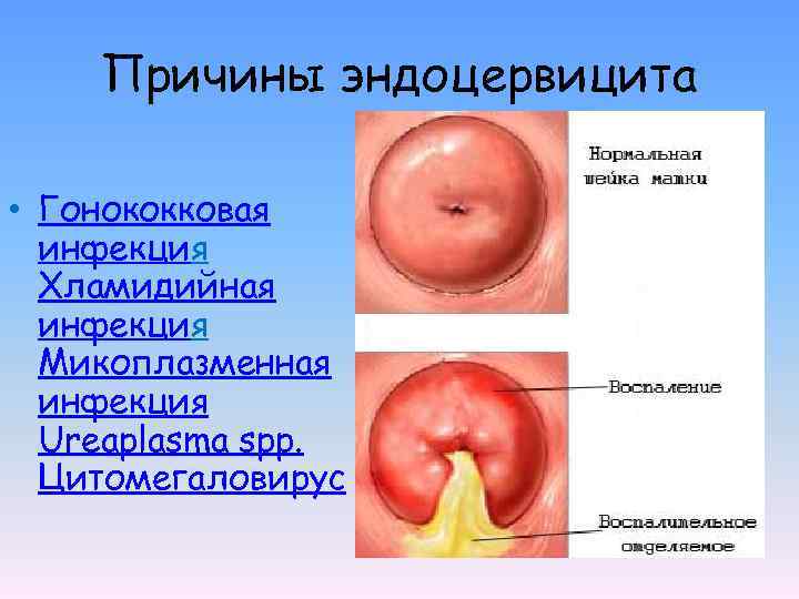 Причины эндоцервицита • Гонококковая инфекция Хламидийная инфекция Микоплазменная инфекция Ureaplasma spp. Цитомегаловирус 