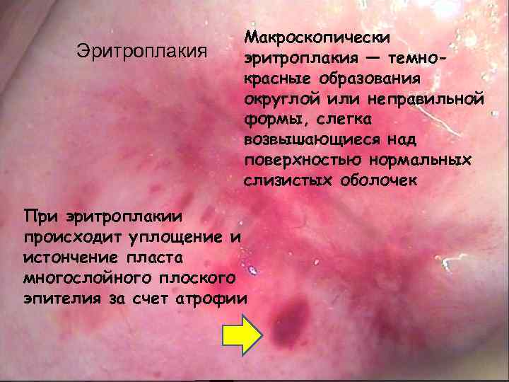 Эритроплакия Макроскопически эритроплакия — темнокрасные образования округлой или неправильной формы, слегка возвышающиеся над поверхностью