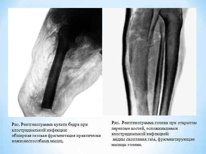 Рис. Рентгенограмма культи бедра при клостридиальной инфекции: обширная газовая фрагментация практически нежизнеспособных мышц. Рис.