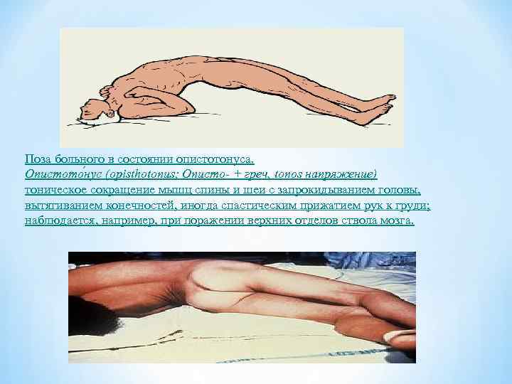 Поза больного в состоянии опистотонуса. Опистото нус (opisthotonus; Описто- + греч, tonos напряжение) тоническое