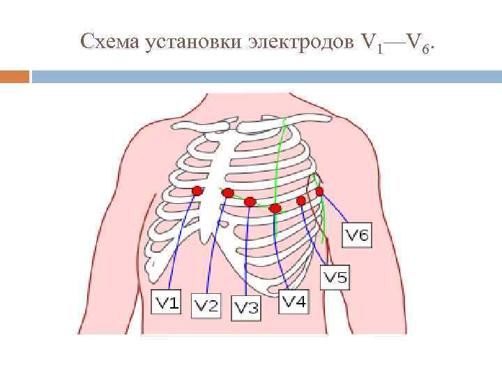 Схема установки электродов V 1—V 6. 